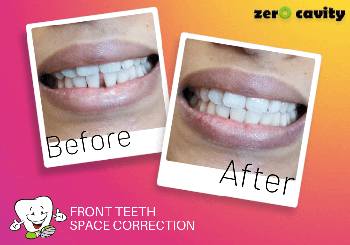 Front Teeth Space Correction